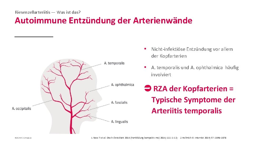 Riesenzellarteriitis — Was ist das? Autoimmune Entzündung der Arterienwände • Nicht-infektiöse Entzündung vor allem