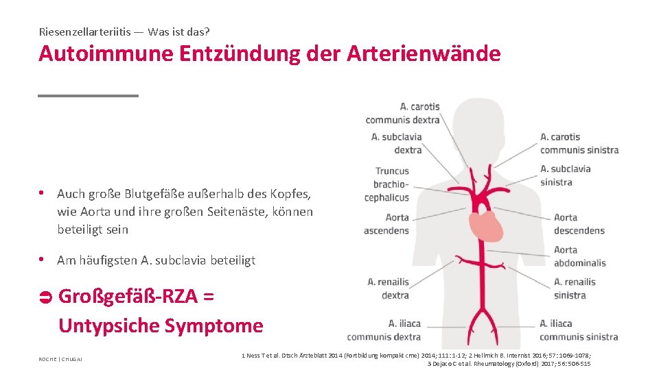 Riesenzellarteriitis — Was ist das? Autoimmune Entzündung der Arterienwände • Auch große Blutgefäße außerhalb