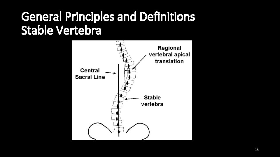 General Principles and Definitions Stable Vertebra 13 