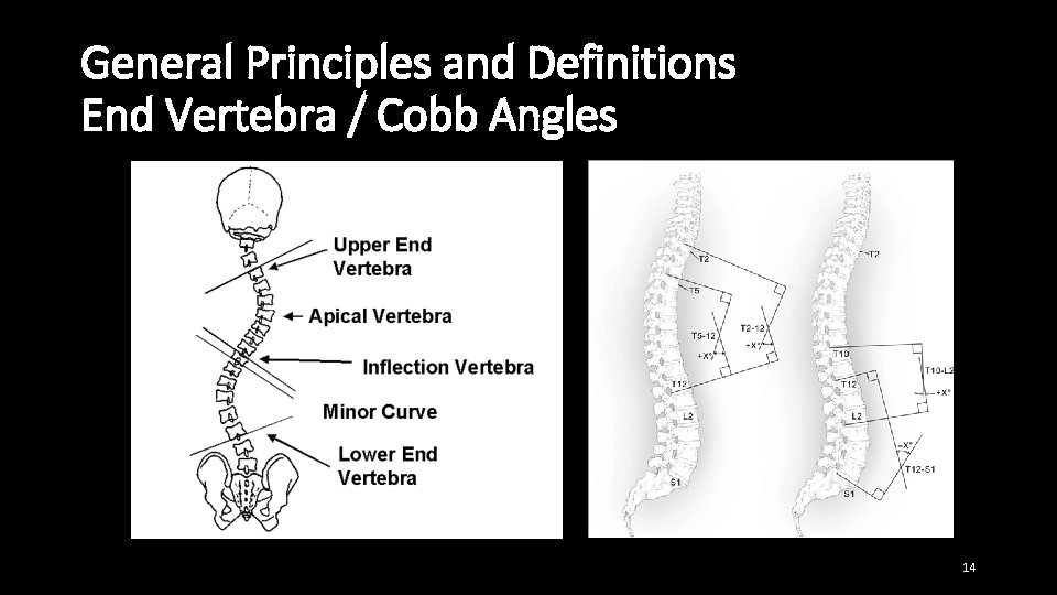 General Principles and Definitions End Vertebra / Cobb Angles 14 