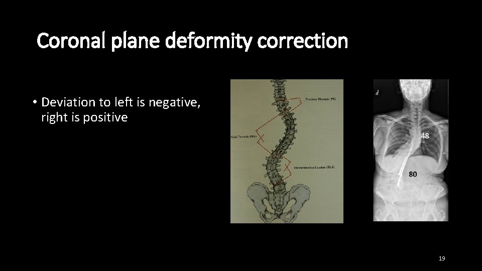 Coronal plane deformity correction • Deviation to left is negative, right is positive 19