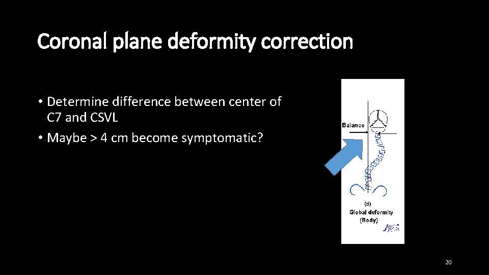 Coronal plane deformity correction • Determine difference between center of C 7 and CSVL