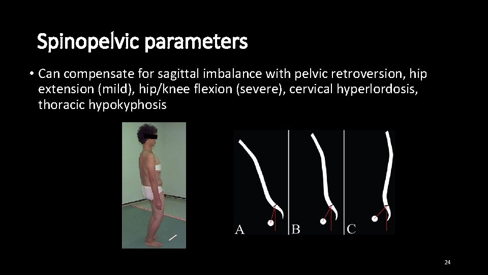 Spinopelvic parameters • Can compensate for sagittal imbalance with pelvic retroversion, hip extension (mild),