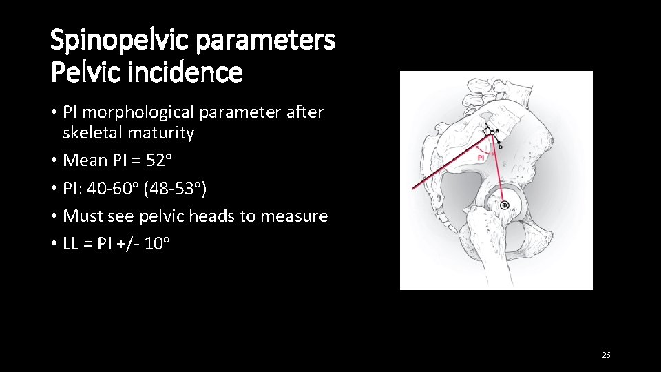 Spinopelvic parameters Pelvic incidence • PI morphological parameter after skeletal maturity • Mean PI