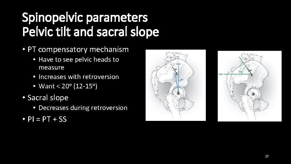 Spinopelvic parameters Pelvic tilt and sacral slope • PT compensatory mechanism • Have to