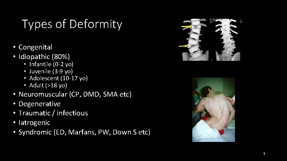 Types of Deformity • Congenital • Idiopathic (80%) • • • Infantile (0 -2