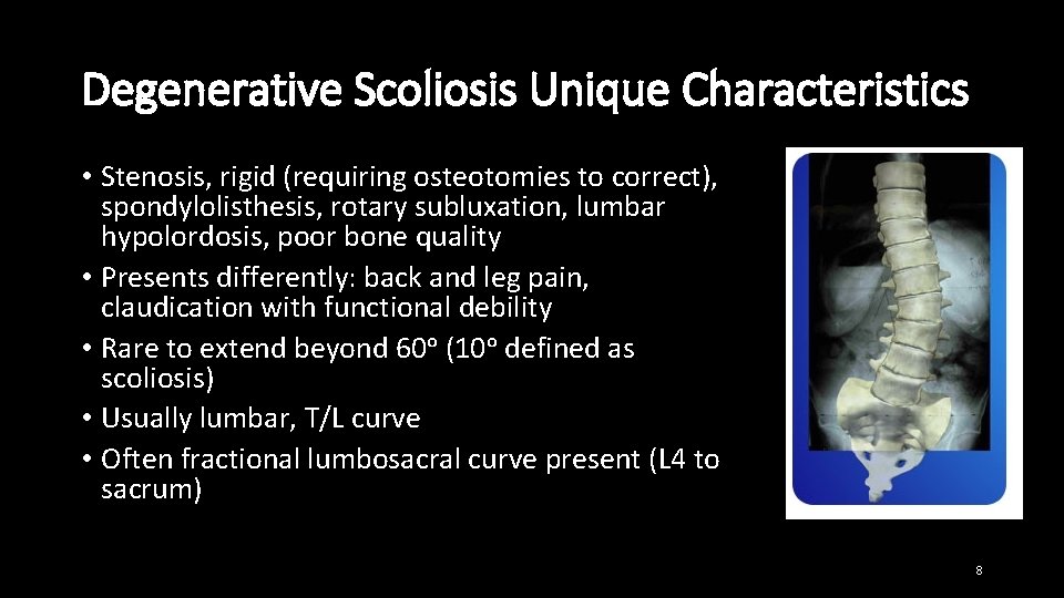 Degenerative Scoliosis Unique Characteristics • Stenosis, rigid (requiring osteotomies to correct), spondylolisthesis, rotary subluxation,