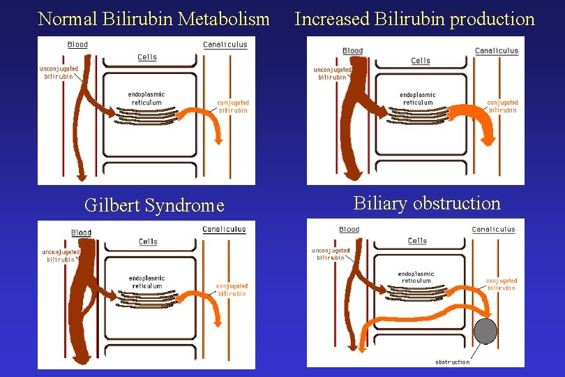Normal Bilirubin Metabolism Gilbert Syndrome Increased Bilirubin production Biliary obstruction 