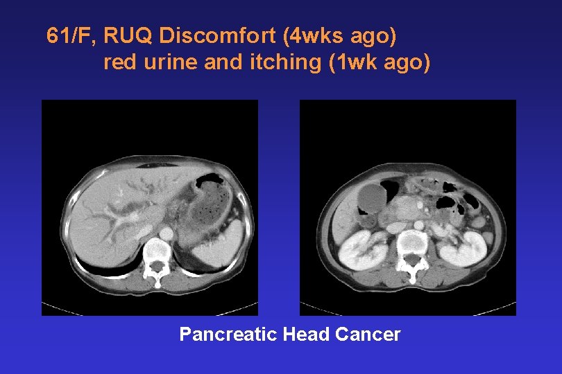 61/F, RUQ Discomfort (4 wks ago) red urine and itching (1 wk ago) Pancreatic