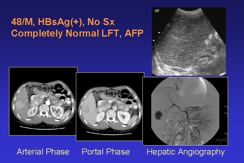 48/M, HBs. Ag(+), No Sx Completely Normal LFT, AFP Arterial Phase Portal Phase Hepatic