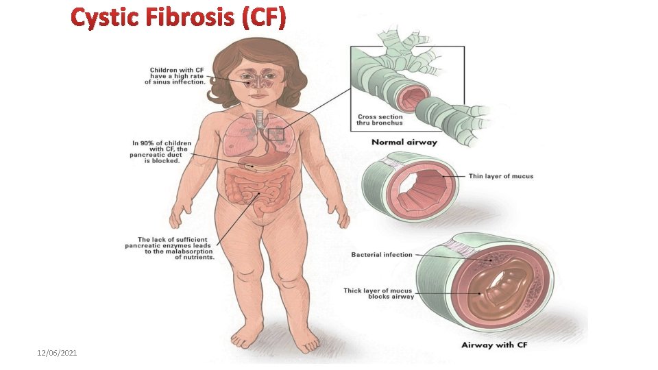 Cystic Fibrosis (CF) 12/06/2021 