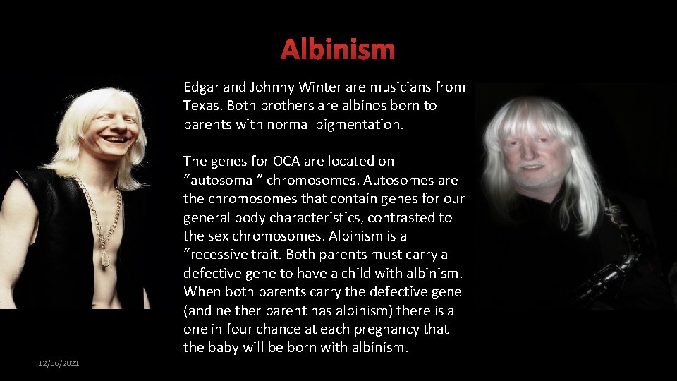 Albinism Edgar and Johnny Winter are musicians from Texas. Both brothers are albinos born