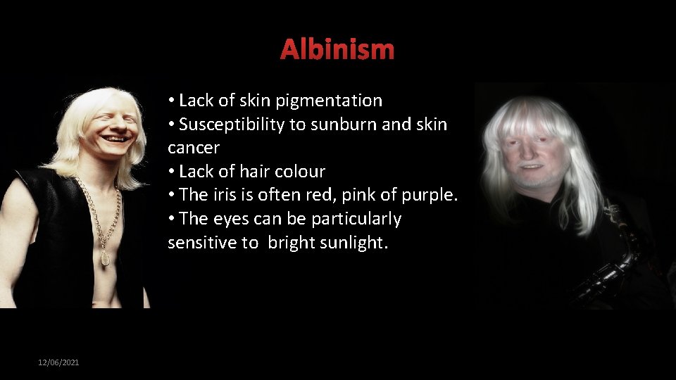 Albinism • Lack of skin pigmentation • Susceptibility to sunburn and skin cancer •