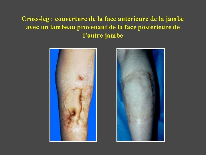 Cross-leg : couverture de la face antérieure de la jambe avec un lambeau provenant