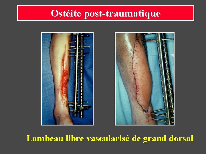 Ostéite post-traumatique Lambeau libre vascularisé de grand dorsal 