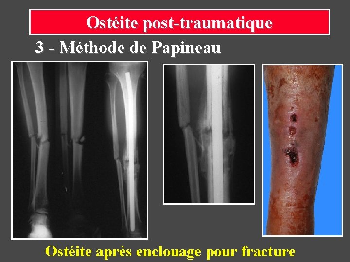 Ostéite post-traumatique 3 - Méthode de Papineau Ostéite après enclouage pour fracture 