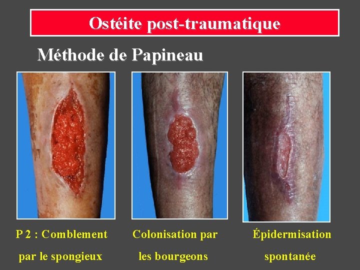 Ostéite post-traumatique Méthode de Papineau P 2 : Comblement Colonisation par Épidermisation par le