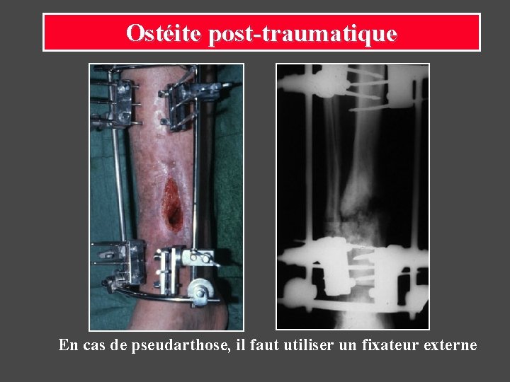 Ostéite post-traumatique En cas de pseudarthose, il faut utiliser un fixateur externe 