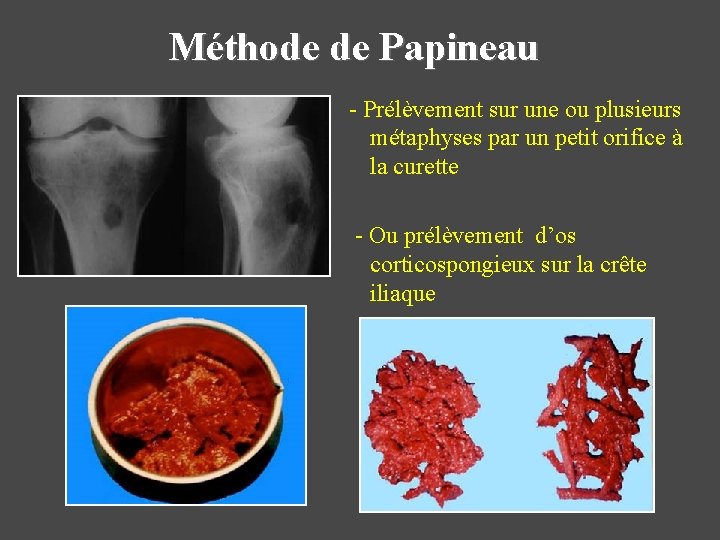Méthode de Papineau - Prélèvement sur une ou plusieurs métaphyses par un petit orifice