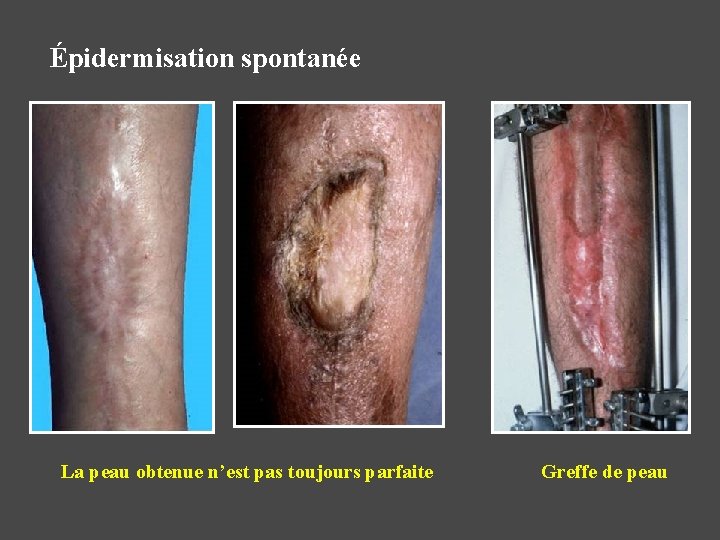 Épidermisation spontanée La peau obtenue n’est pas toujours parfaite Greffe de peau 