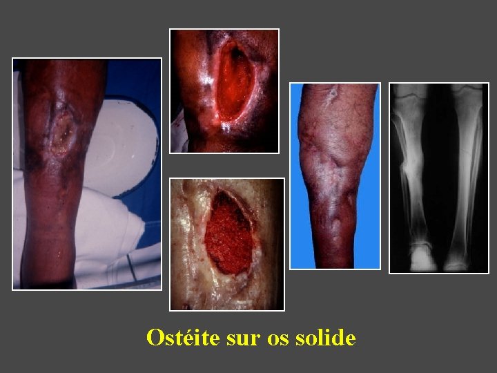 Ostéite sur os solide 