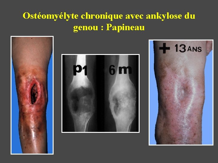 Ostéomyélyte chronique avec ankylose du genou : Papineau 