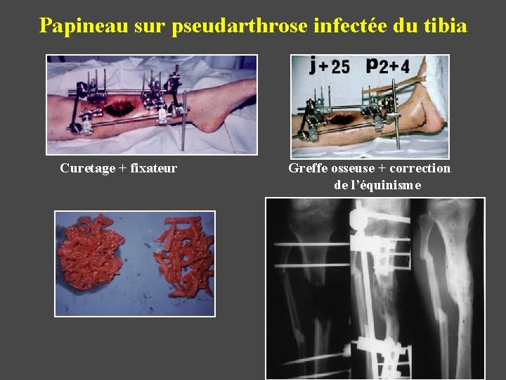 Papineau sur pseudarthrose infectée du tibia Curetage + fixateur Greffe osseuse + correction de