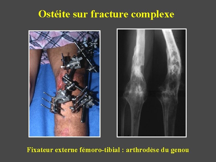 Ostéite sur fracture complexe Fixateur externe fémoro-tibial : arthrodèse du genou 