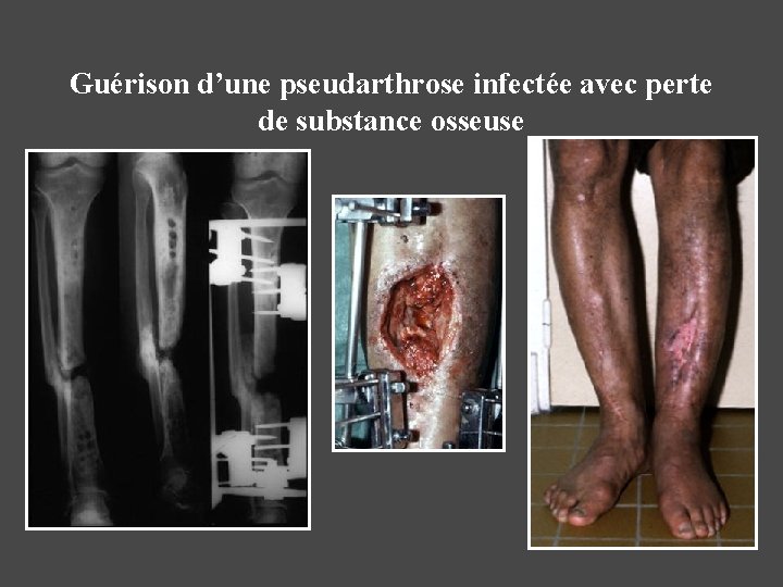 Guérison d’une pseudarthrose infectée avec perte de substance osseuse 