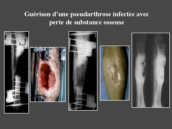 Guérison d’une pseudarthrose infectée avec perte de substance osseuse 