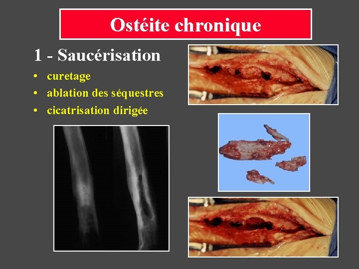 Ostéite chronique 1 - Saucérisation • curetage • ablation des séquestres • cicatrisation dirigée