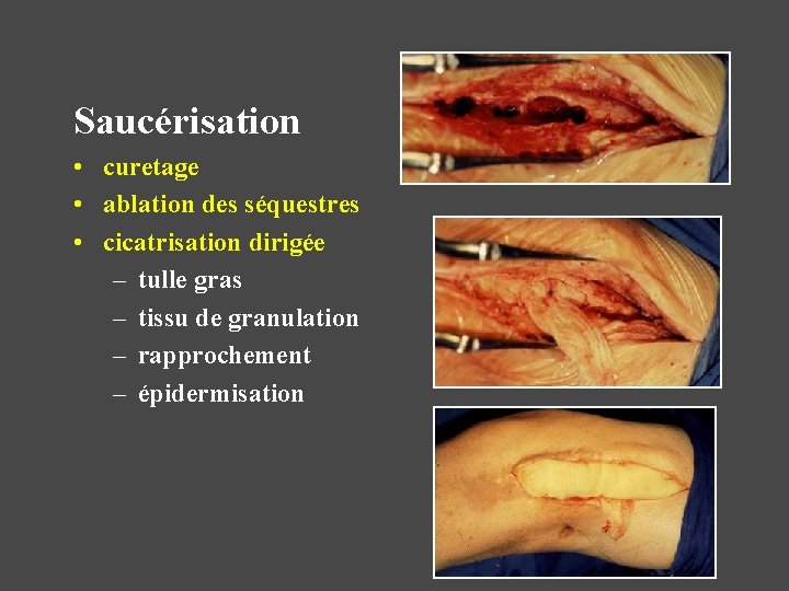 Saucérisation • curetage • ablation des séquestres • cicatrisation dirigée – tulle gras –
