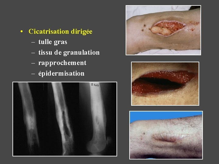  • Cicatrisation dirigée – tulle gras – tissu de granulation – rapprochement –