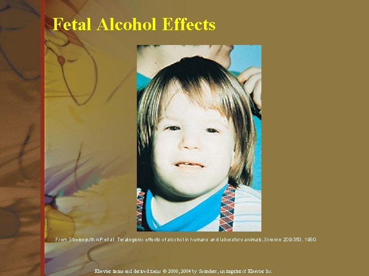 Fetal Alcohol Effects From Streissguth AP et al: Teratogenic effects of alcohol in humans