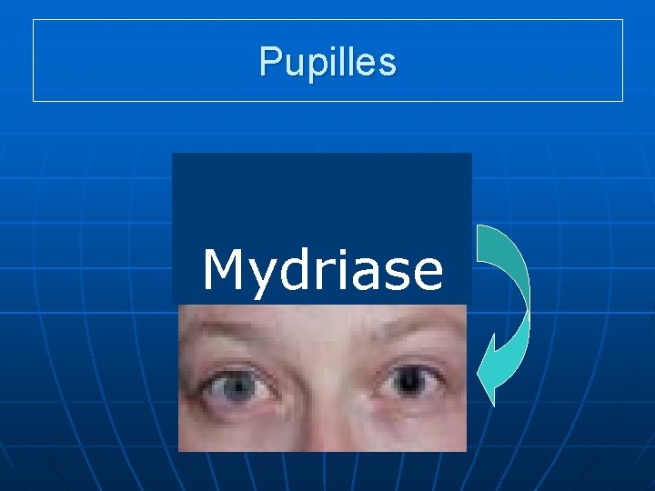 Pupilles AAAAAA Mydriase 