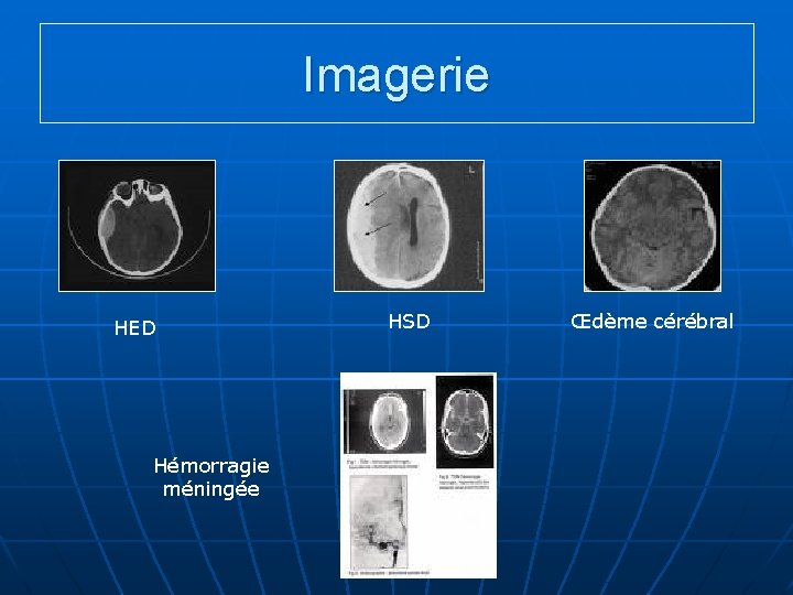 Imagerie HED Hémorragie méningée HSD Œdème cérébral 