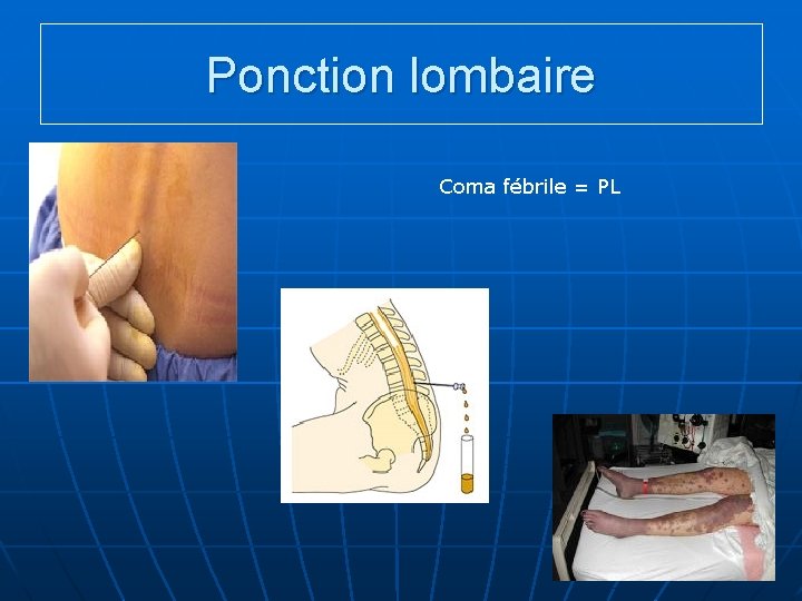 Ponction lombaire Coma fébrile = PL 