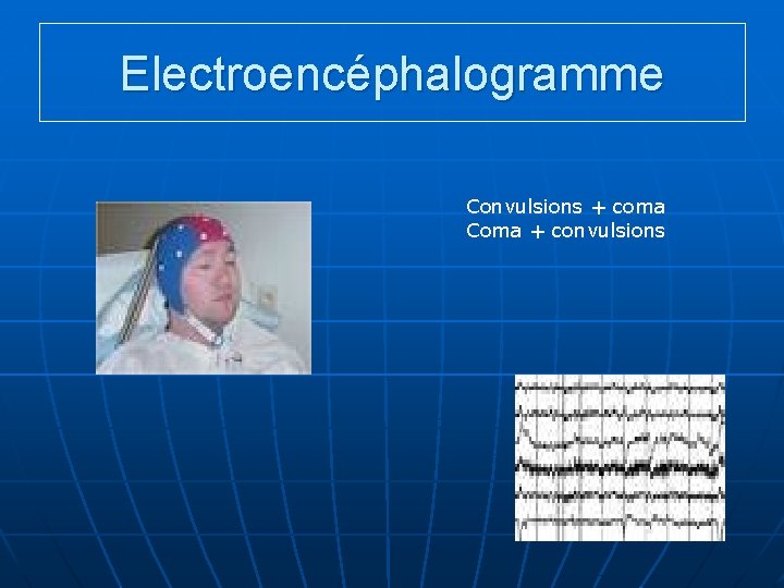 Electroencéphalogramme Convulsions + coma Coma + convulsions 