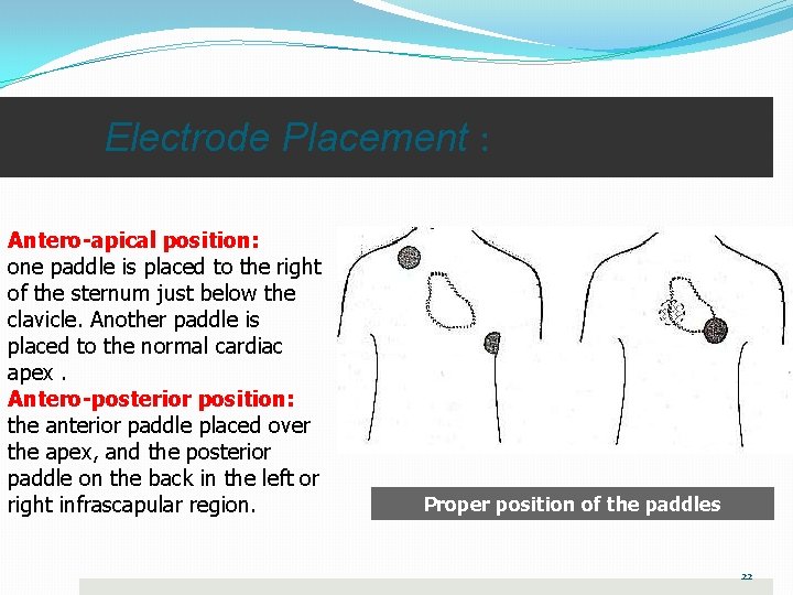 Electrode Placement : Antero-apical position: one paddle is placed to the right of the Electrode Placement : Antero-apical position: one paddle is placed to the right of the