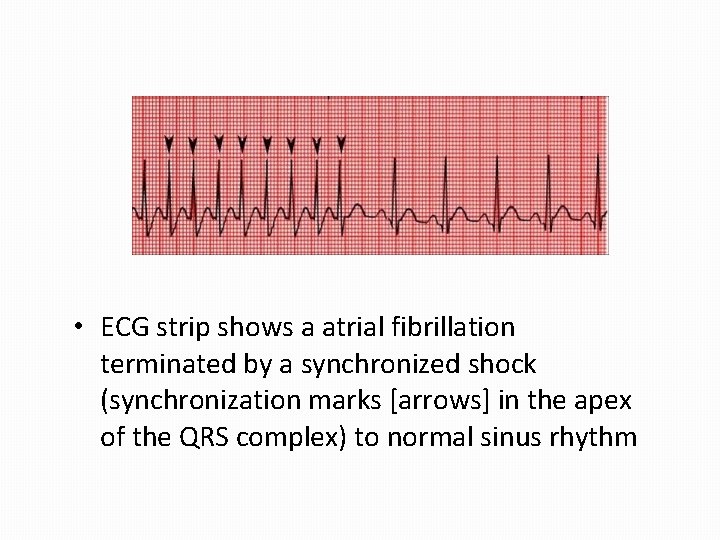  • ECG strip shows a atrial fibrillation terminated by a synchronized shock (synchronization