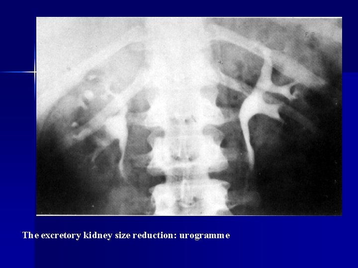 The excretory kidney size reduction: urogramme 