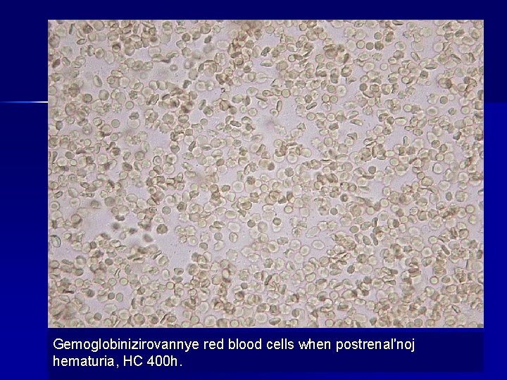 Gemoglobinizirovannye red blood cells when postrenal′noj hematuria, HC 400 h. 