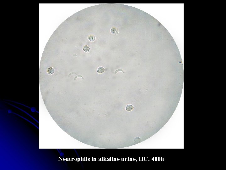 Neutrophils in alkaline urine, HC. 400 h 