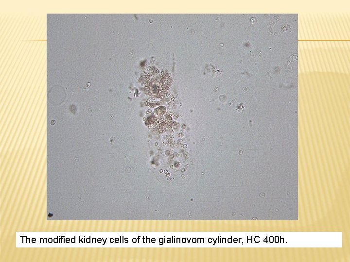 The modified kidney cells of the gialinovom cylinder, HC 400 h. 