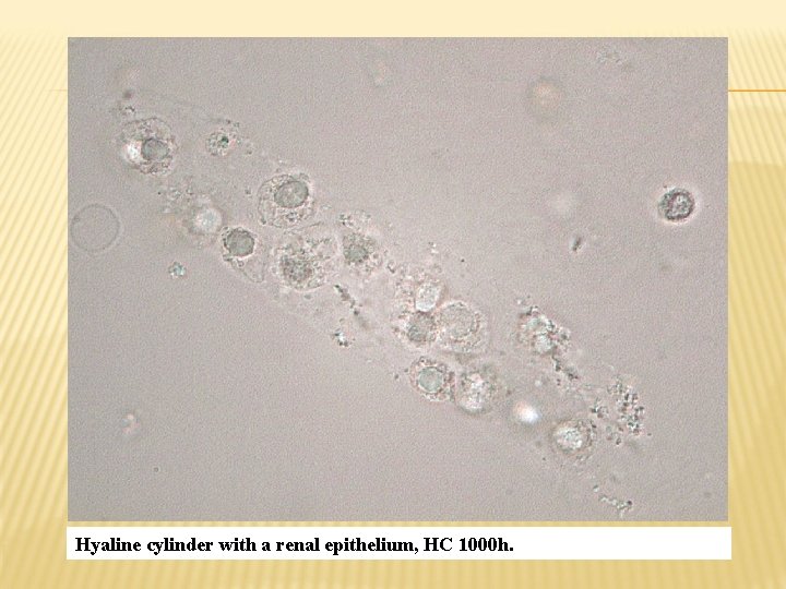 Hyaline cylinder with a renal epithelium, HC 1000 h. 