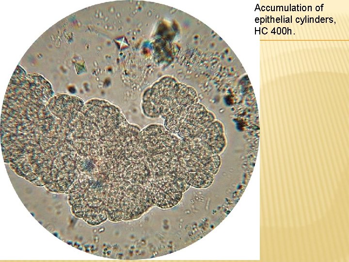 Accumulation of epithelial cylinders, HC 400 h. 