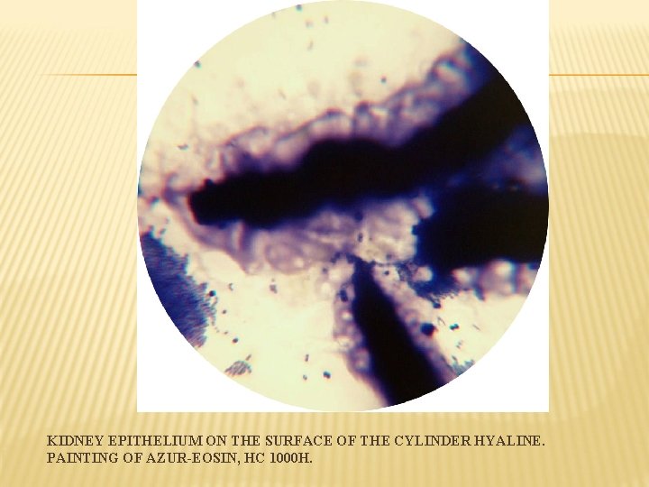 KIDNEY EPITHELIUM ON THE SURFACE OF THE CYLINDER HYALINE. PAINTING OF AZUR-EOSIN, HC 1000