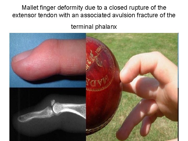 Mallet finger deformity due to a closed rupture of the extensor tendon with an