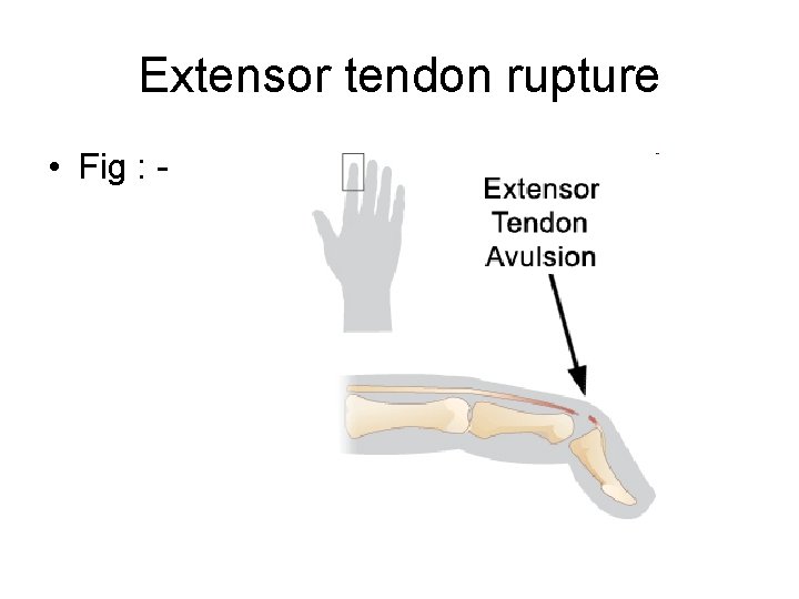 Extensor tendon rupture • Fig : - 