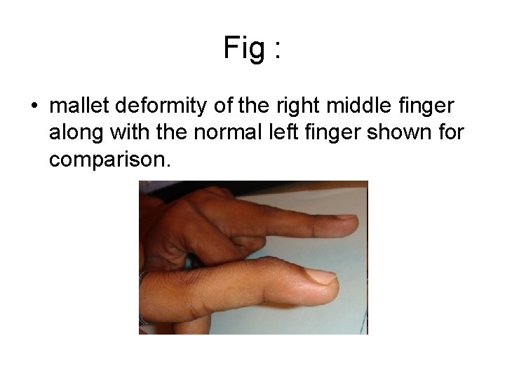 Fig : • mallet deformity of the right middle finger along with the normal